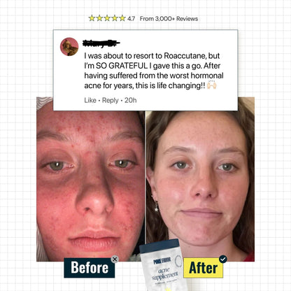 Acne Supplement